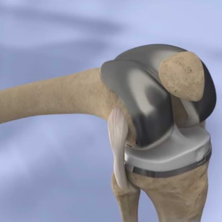 Pros and Cons of Knee Replacement