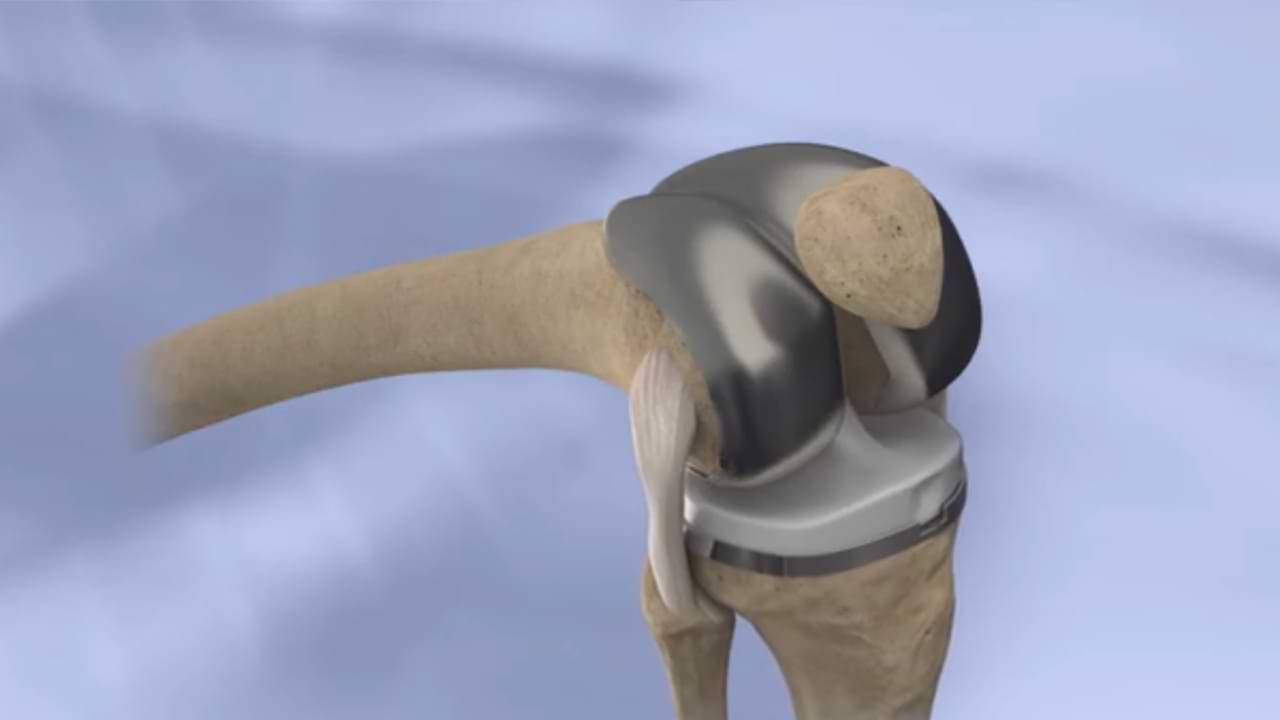 Pros and Cons of Knee Replacement