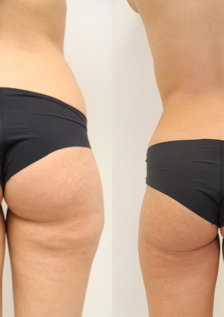 About The Different Types of Liposuction Procedures That We Need to Know