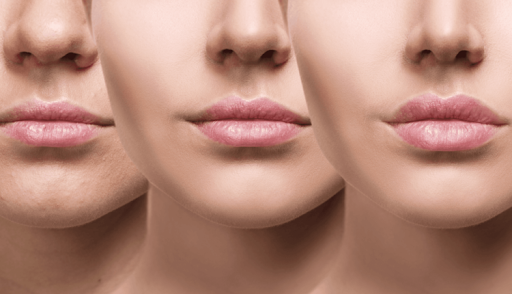 Everything You Might Want To Know About Lip Filler Swelling Stages