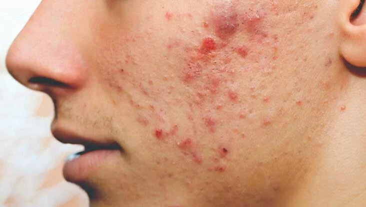 Face Acne And Pimples